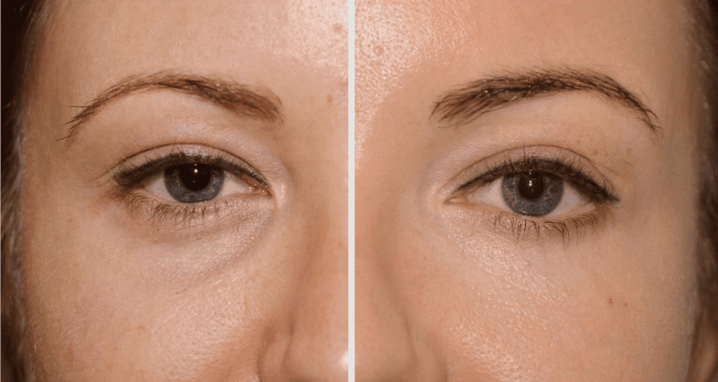 Vorher/Nachher Ergebnis: Eigenfett Augenringe