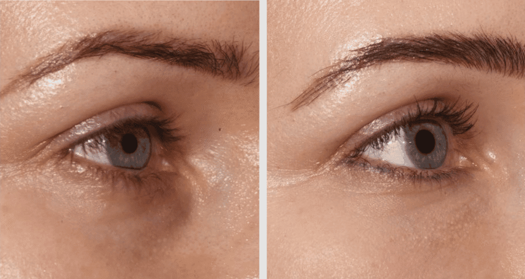 Vorher/Nachher Ergebnis: Eigenfett Augenringe