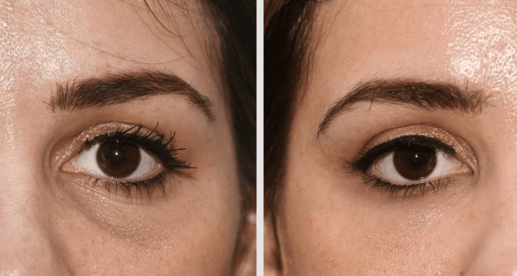 Vorher/Nachher Ergebnis: Eigenfett Augenringe