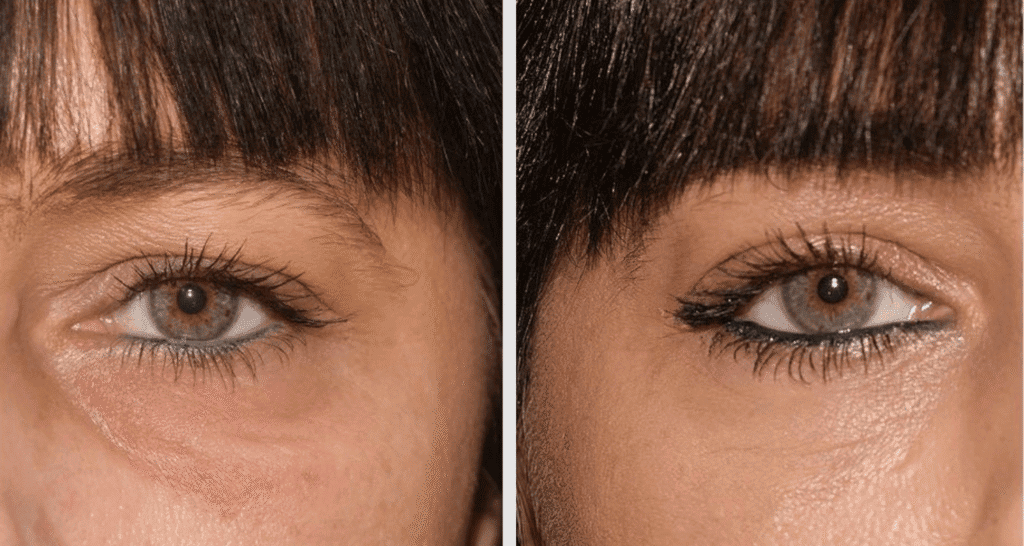 Vorher/Nachher Ergebnis: Eigenfett Augenringe