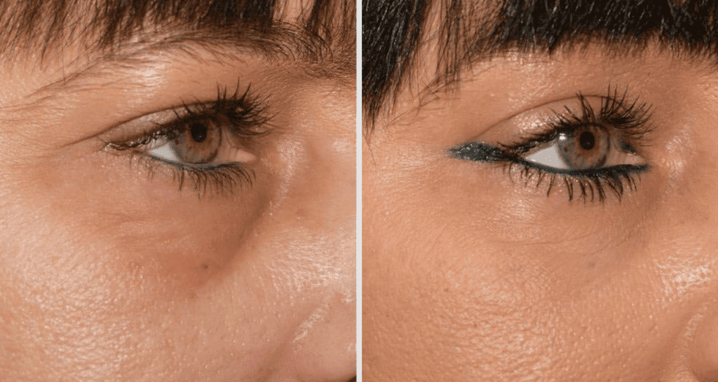 Vorher/Nachher Ergebnis: Eigenfett Augenringe