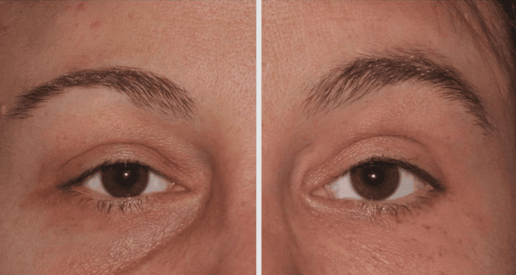 Vorher/Nachher Ergebnis: Eigenfett Augenringe