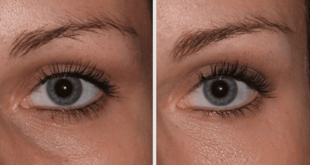 Vorher/Nachher Ergebnis: Eigenfett Augenringe