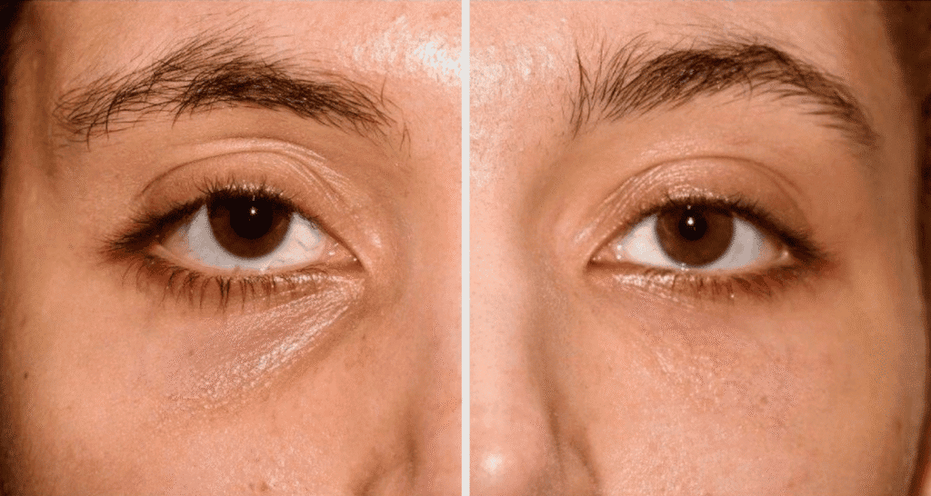 Vorher/Nachher Ergebnis: Eigenfett Augenringe