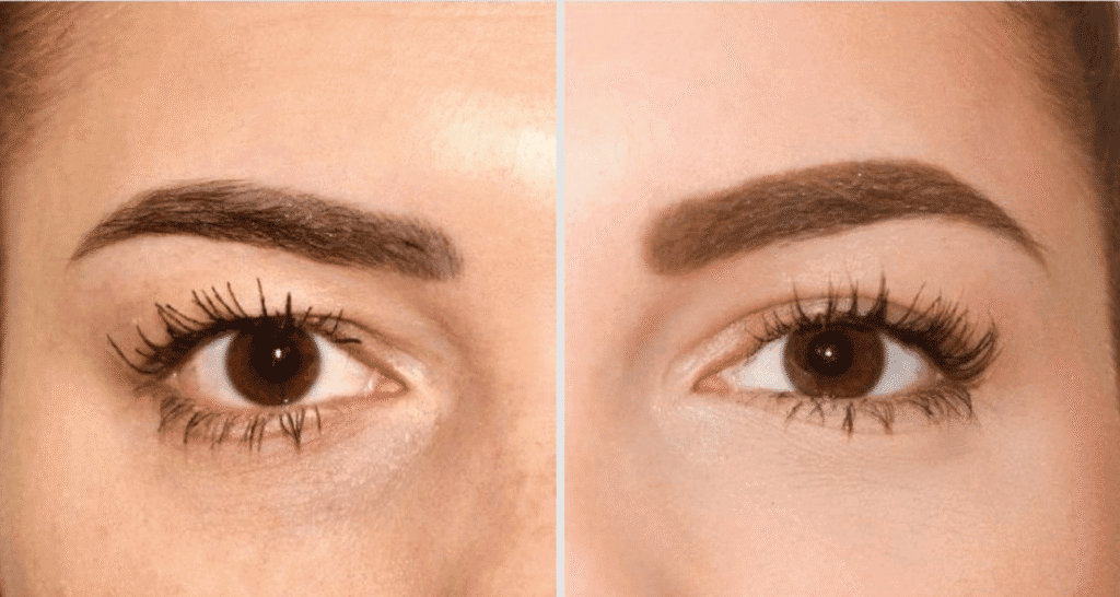 Vorher/Nachher Ergebnis: Eigenfett Augenringe