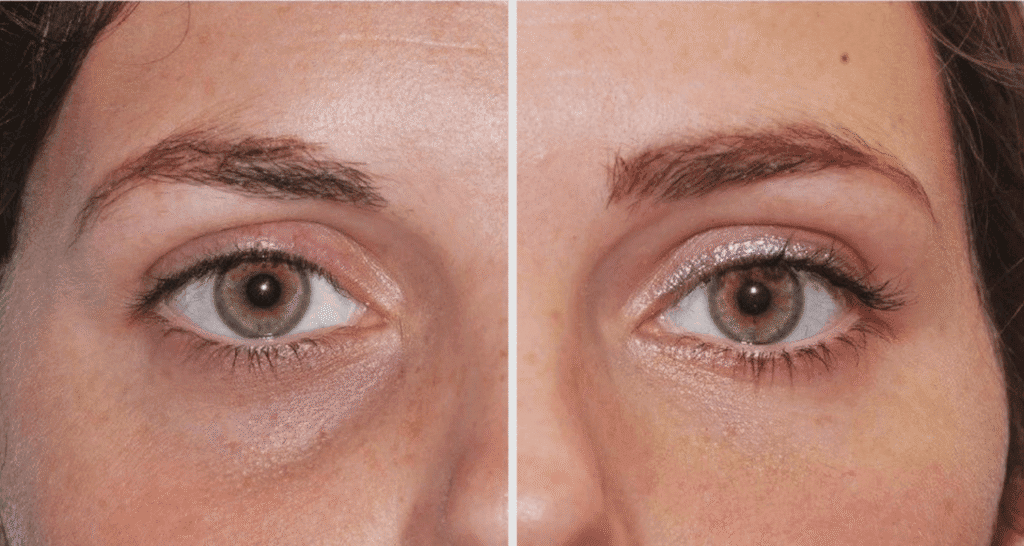 Vorher/Nachher Ergebnis: Eigenfett Augenringe