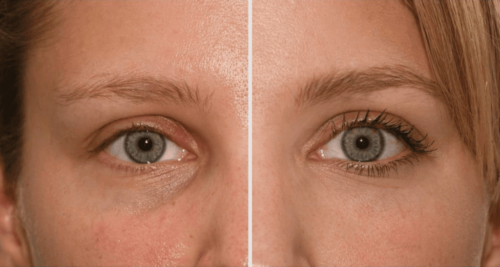 Vorher/Nachher Ergebnis: Eigenfett Augenringe