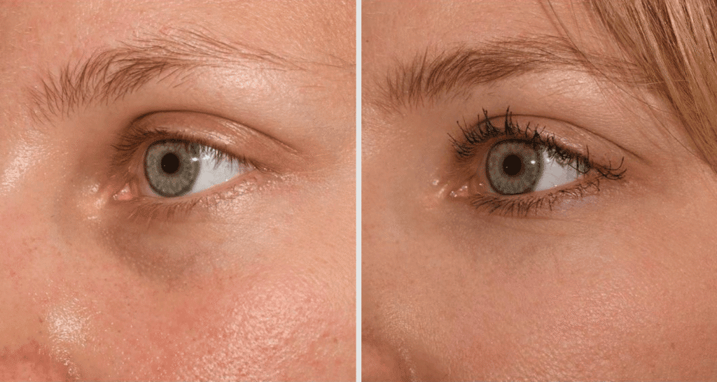 Vorher/Nachher Ergebnis: Eigenfett Augenringe