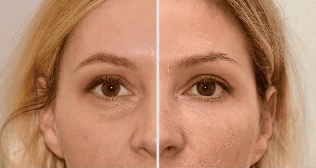 Vorher/Nachher Ergebnis: Eigenfett Augenringe