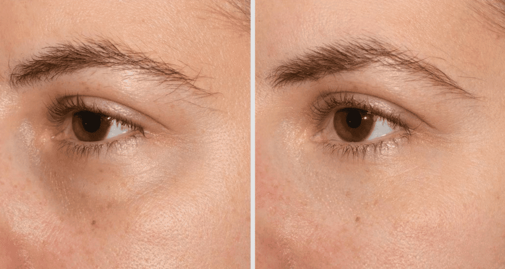 Vorher/Nachher Ergebnis: Eigenfett Augenringe
