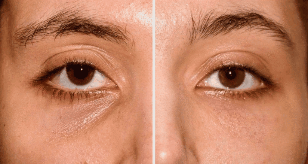 Vorher/Nachher Ergebnis: Eigenfett Augenringe