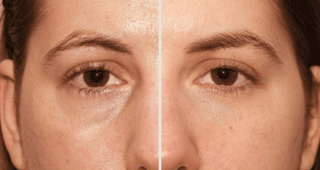 Vorher/Nachher Ergebnis: Eigenfett Augenringe