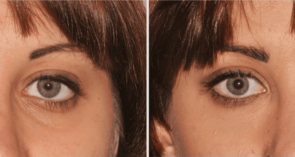 Vorher/Nachher Ergebnis: Eigenfett Augenringe