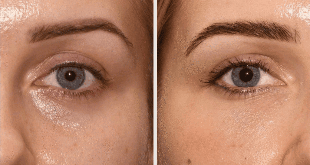 Vorher/Nachher Ergebnis: Eigenfett Augenringe