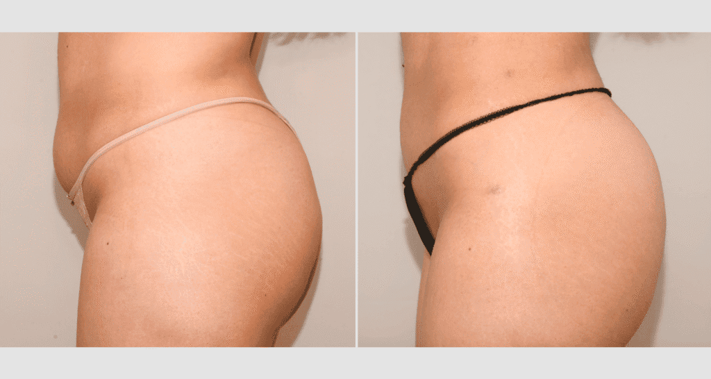 Vorher/Nachher Ergebnis: Eigenfett Bbl