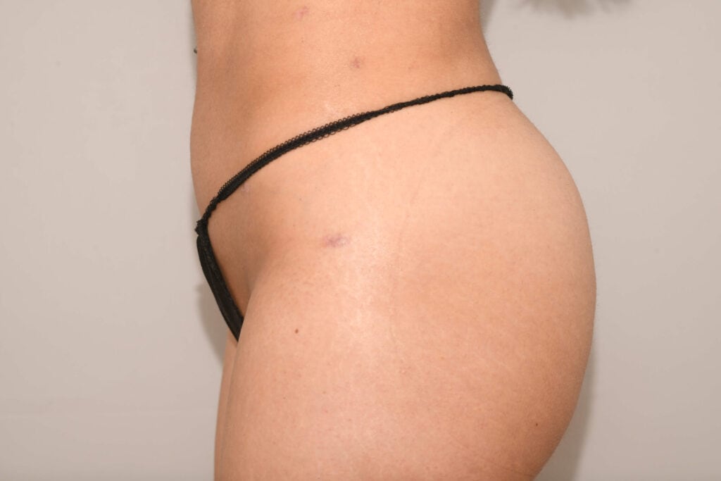 Vorher/Nachher Ergebnis: Eigenfett Bbl 12 Scaled