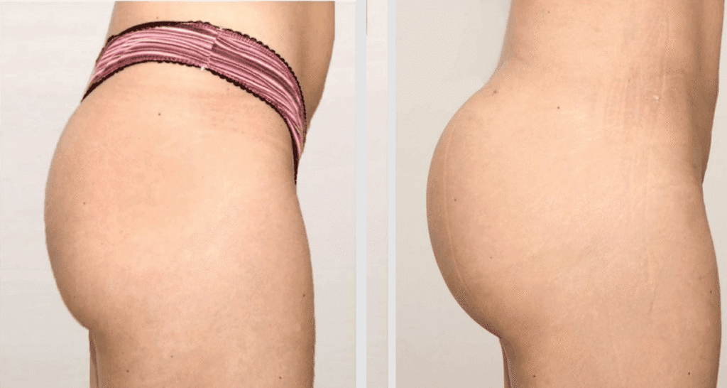 Vorher/Nachher Ergebnis: Eigenfett Bbl