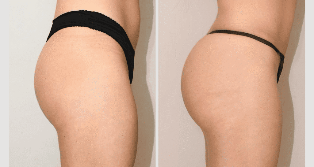 Vorher/Nachher Ergebnis: Eigenfett Bbl