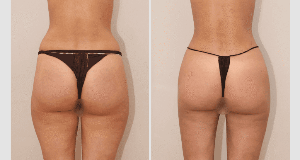 Vorher/Nachher Ergebnis: Eigenfett Bbl