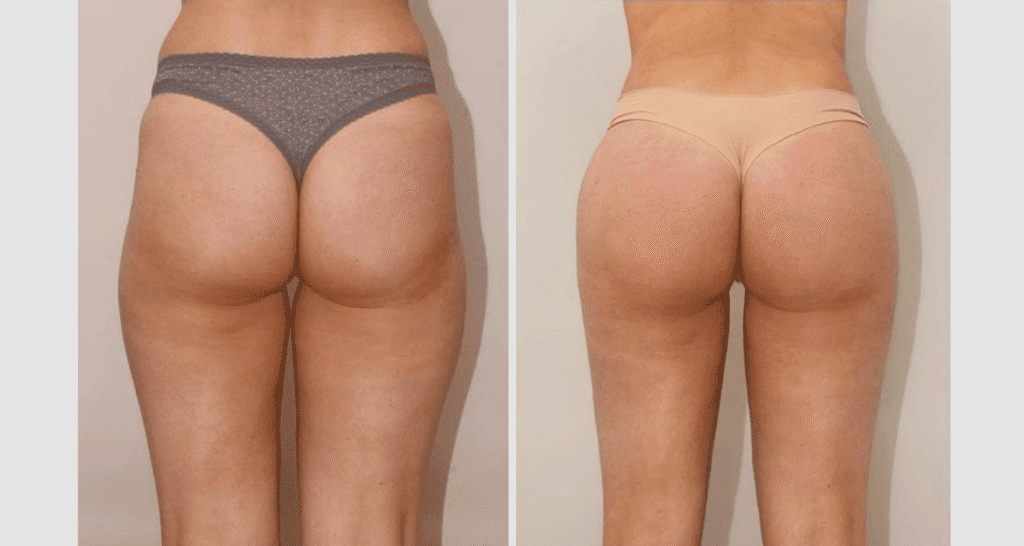 Vorher/Nachher Ergebnis: Eigenfett Bbl