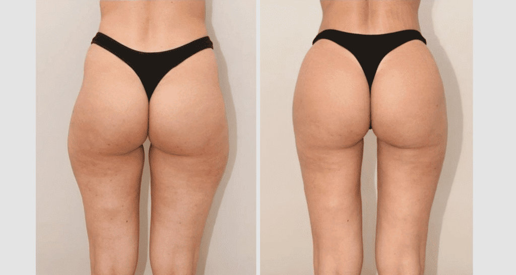 Vorher/Nachher Ergebnis: Eigenfett Bbl