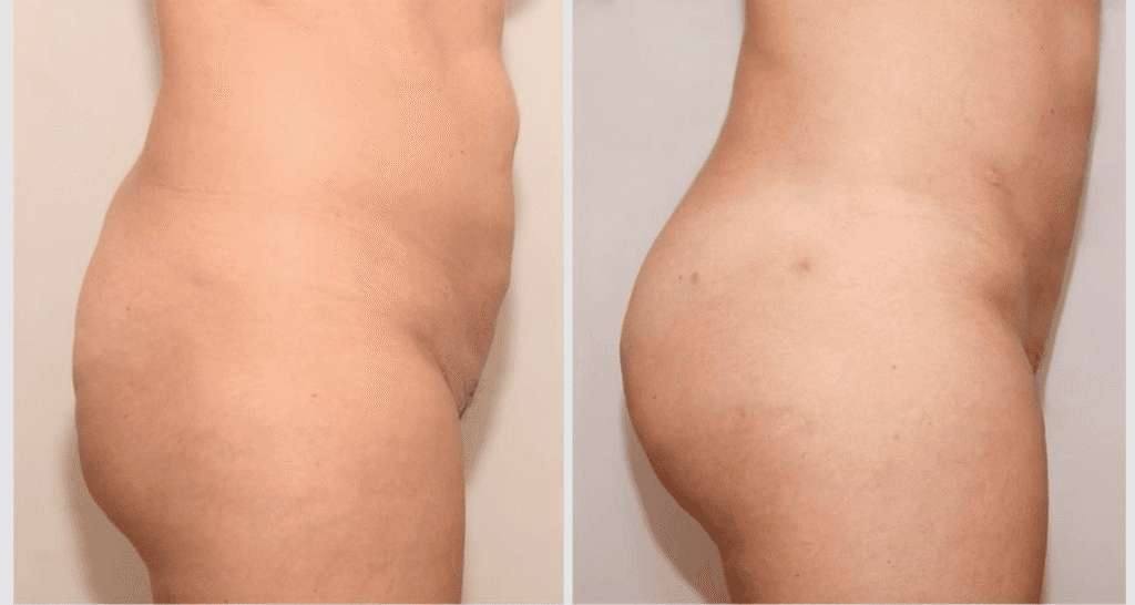 Vorher/Nachher Ergebnis: Eigenfett Bbl