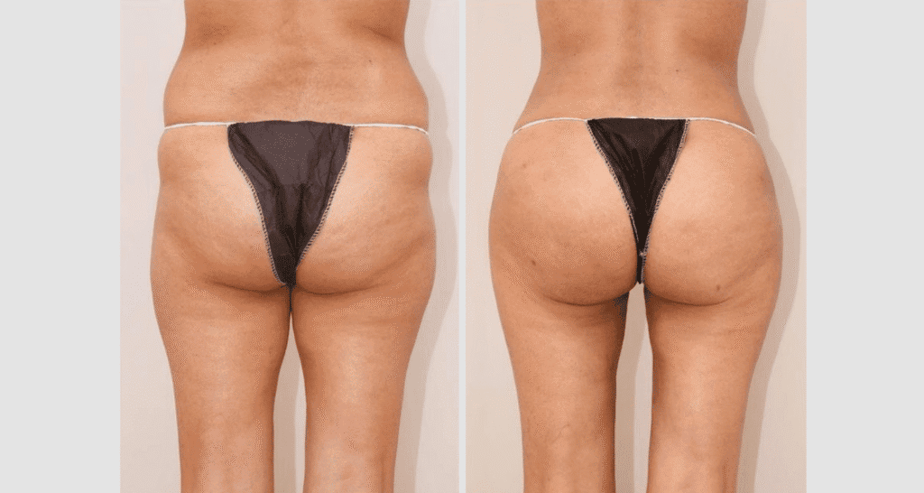 Vorher/Nachher Ergebnis: Eigenfett Bbl