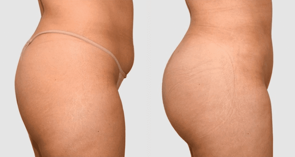 Vorher/Nachher Ergebnis: Eigenfett Bbl