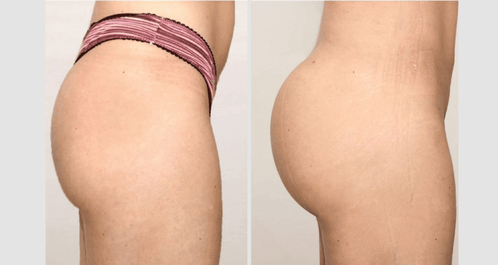 Vorher/Nachher Ergebnis: Eigenfett Bbl