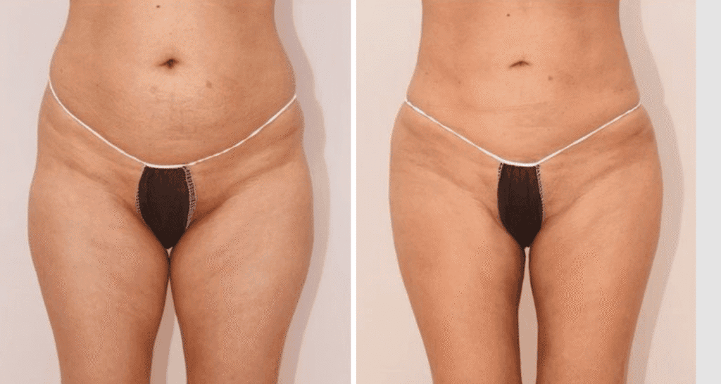 Vorher und Nachher Bilder einer Eigenfetttransplantation im Bauchbereich.