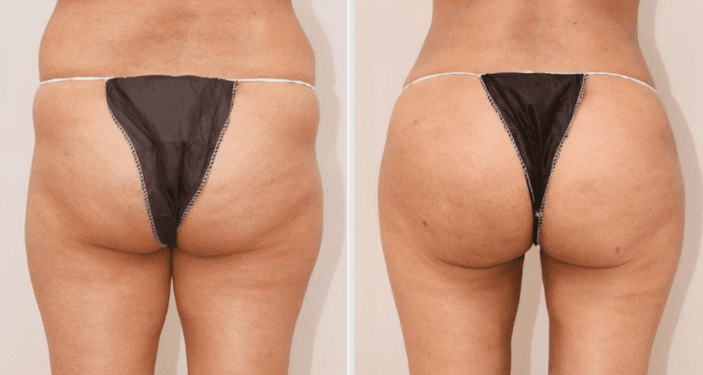 Vorher/Nachher Ergebnis: Eigenfett Bodyforming