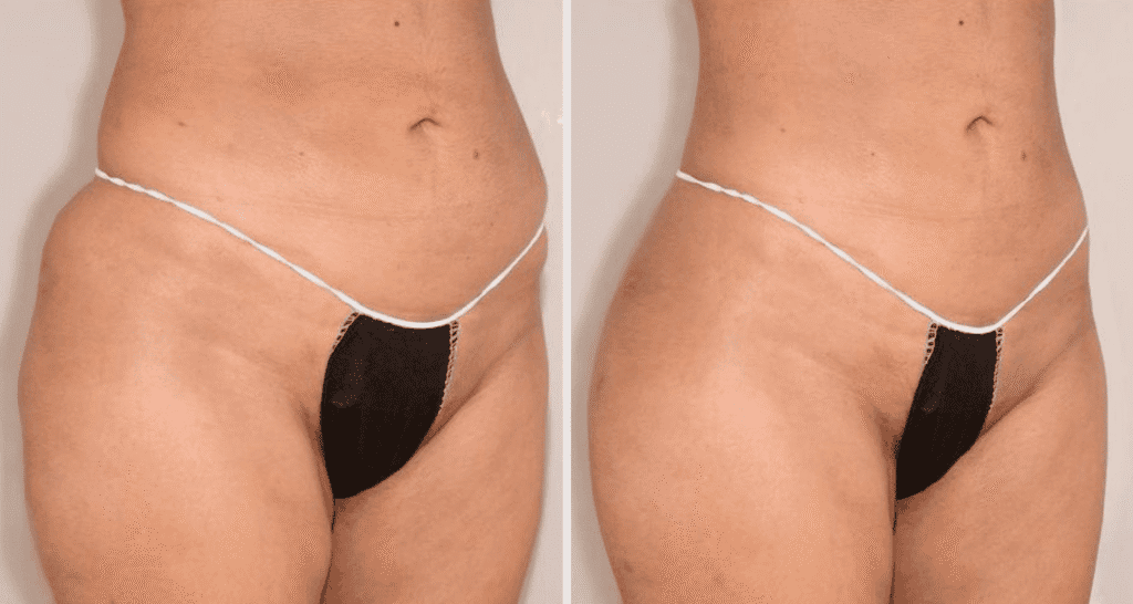 Vorher/Nachher Ergebnis: Eigenfett Bodyforming