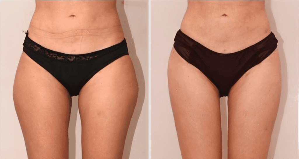 Vorher/Nachher Ergebnis: Eigenfett Bodyforming