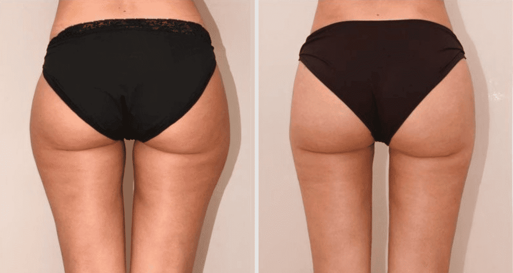 Vorher/Nachher Ergebnis: Eigenfett Bodyforming