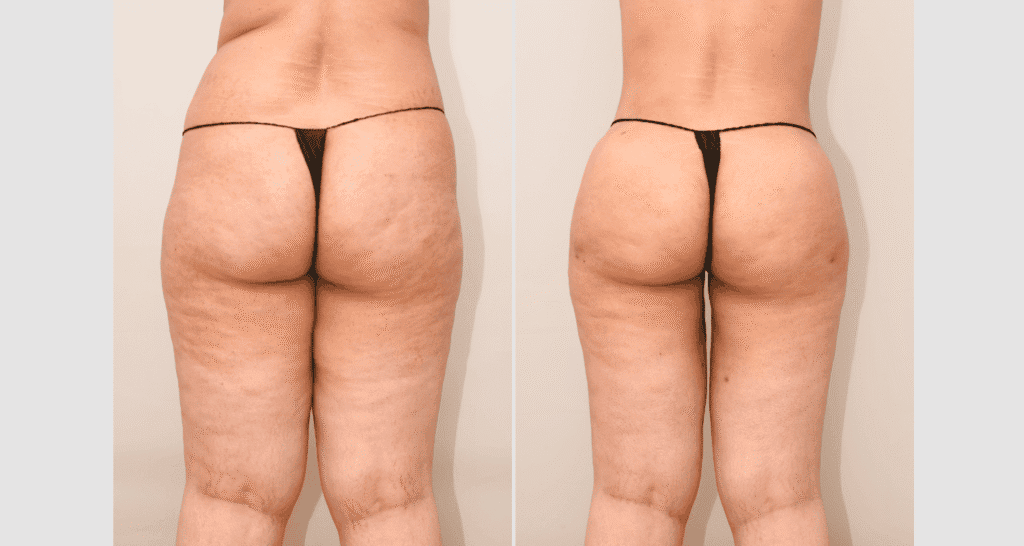 Vorher/Nachher Ergebnis: Eigenfett Bodyforming