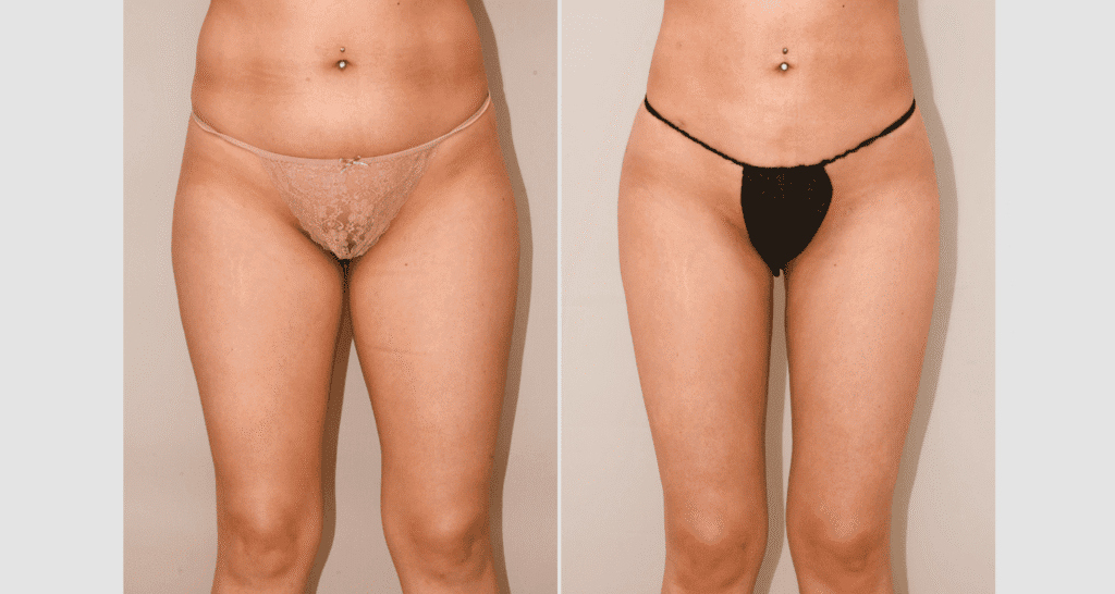 Vorher/Nachher Ergebnis: Eigenfett Bodyforming