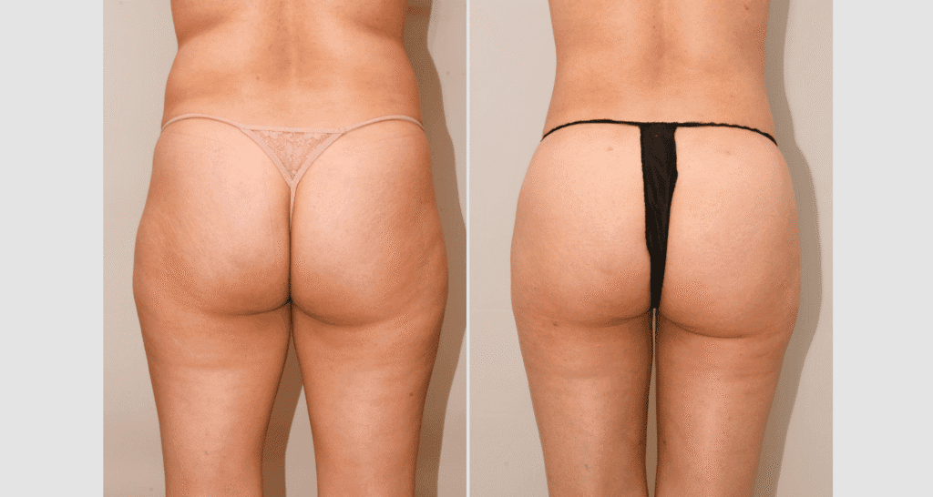 Vorher/Nachher Ergebnis: Eigenfett Bodyforming