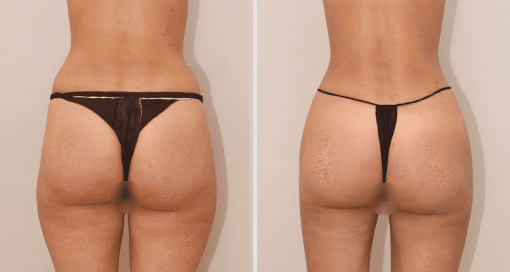 Vorher/Nachher Ergebnis: Eigenfett Bodyforming