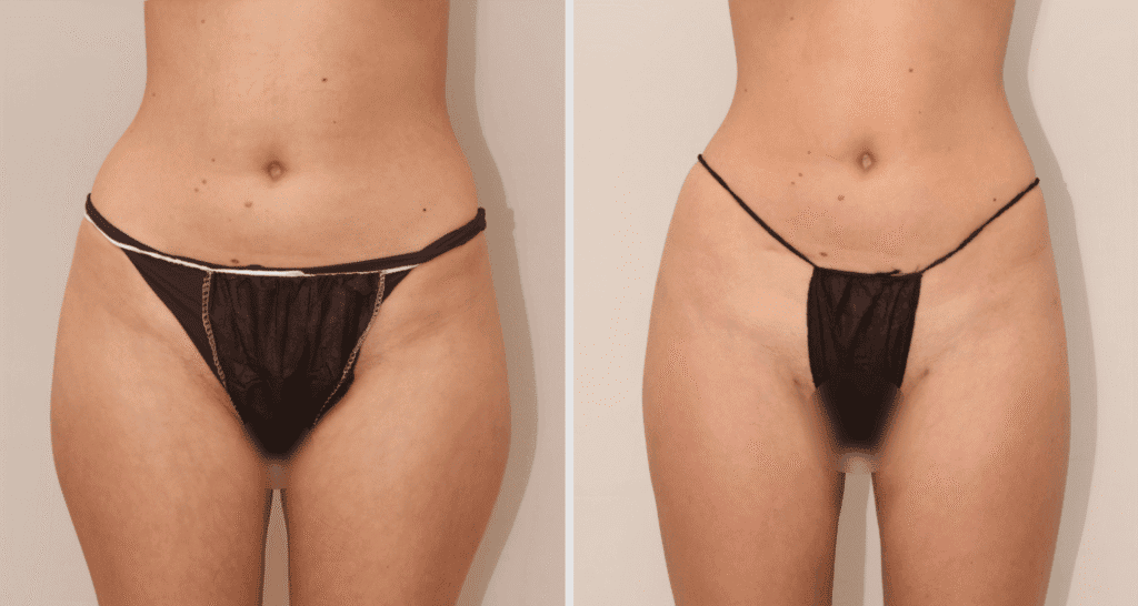 Vorher/Nachher Ergebnis: Eigenfett Bodyforming