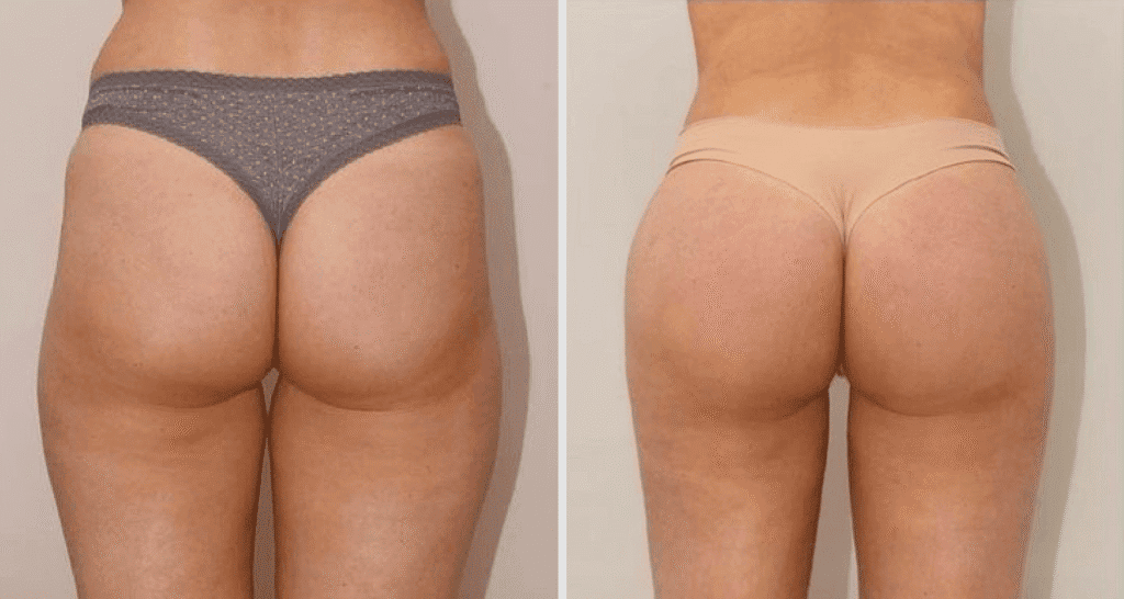 Vorher/Nachher Ergebnis: Eigenfett Bodyforming