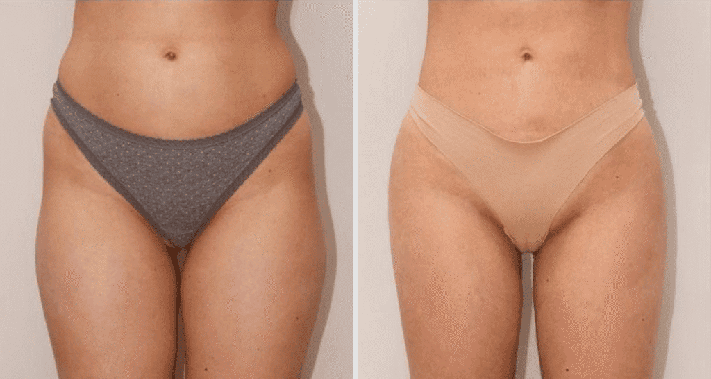 Vorher/Nachher Ergebnis: Eigenfett Bodyforming