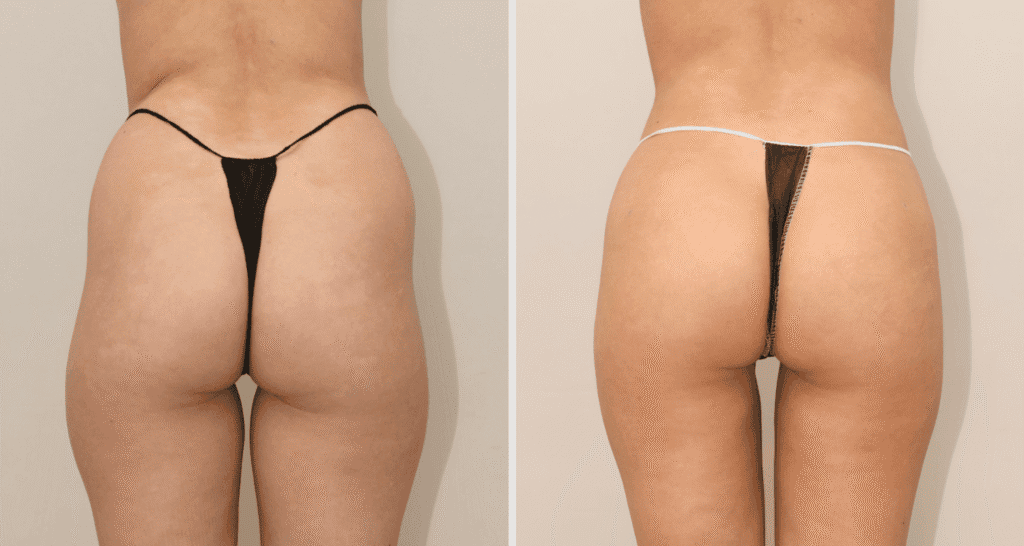 Vorher/Nachher Ergebnis: Eigenfett Bodyforming