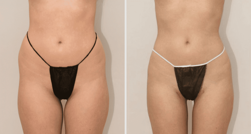 Vorher/Nachher Ergebnis: Eigenfett Bodyforming