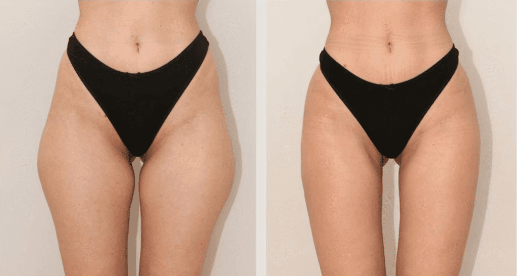 Vorher/Nachher Ergebnis: Eigenfett Bodyforming