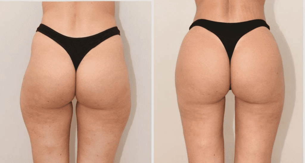 Vorher/Nachher Ergebnis: Eigenfett Bodyforming