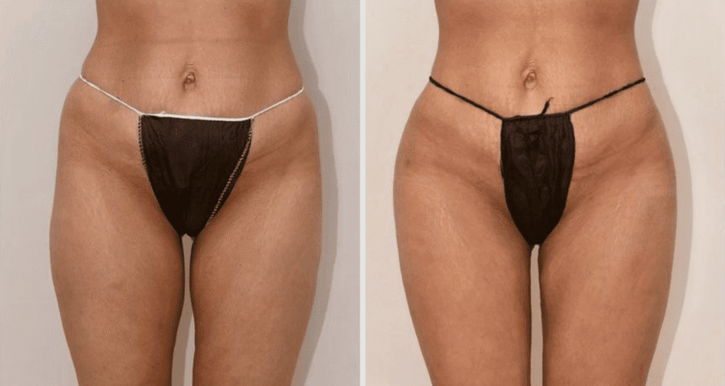 Vorher/Nachher Ergebnis: Eigenfett Bodyforming