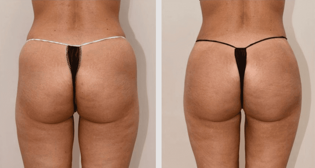 Vorher/Nachher Ergebnis: Eigenfett Bodyforming