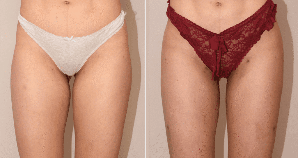 Vorher/Nachher Ergebnis: Eigenfett Bodyforming