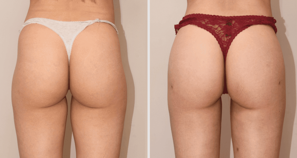 Vorher/Nachher Ergebnis: Eigenfett Bodyforming