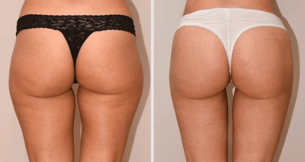 Vorher/Nachher Ergebnis: Eigenfett Bodyforming